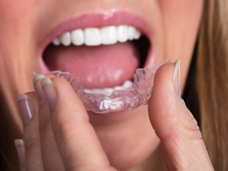 How Long Does Teeth Aligner Treatment Last?