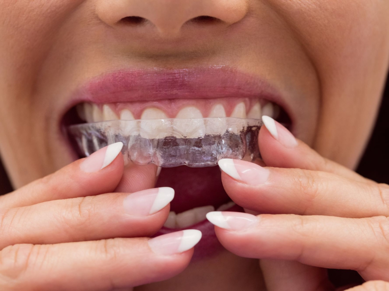 How do Clear Aligners Work?